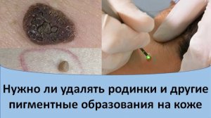 Нужно ли удалять родинки и другие новообразования на коже
