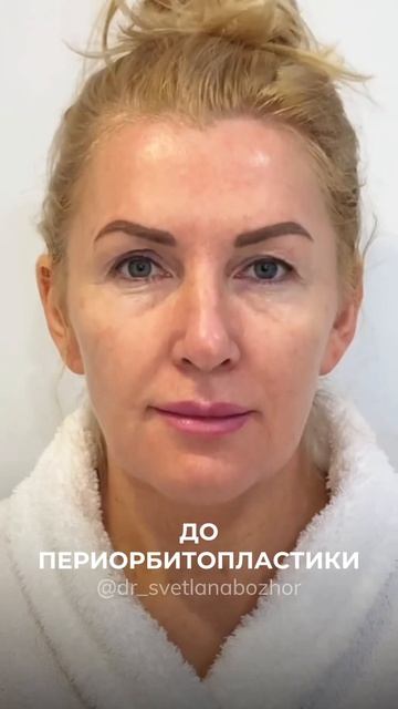 Периорбитопластика. Пластический хирург Светлана Божор #пластикалица