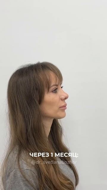 Повторная ринопластика. Пластический хирург Светлана Божор #ринопластика