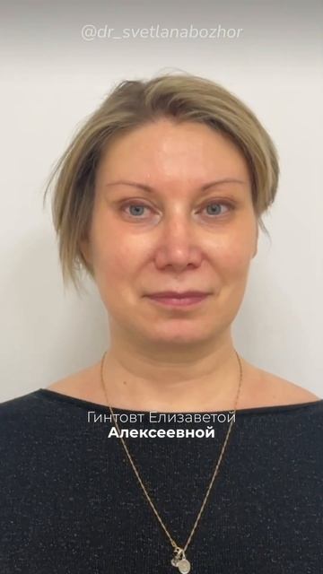 Периорбитопластика. Пластический хирург Светлана Божор #пластикалица
