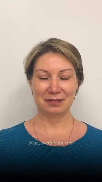 Периорбитопластика. Пластический хирург Светлана Божор #периорбитопластика