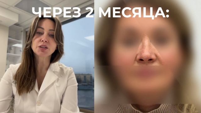 Посттравматическая деформация носа. Ринопластика. Пластический хирург Светлана Божор #ринопластика