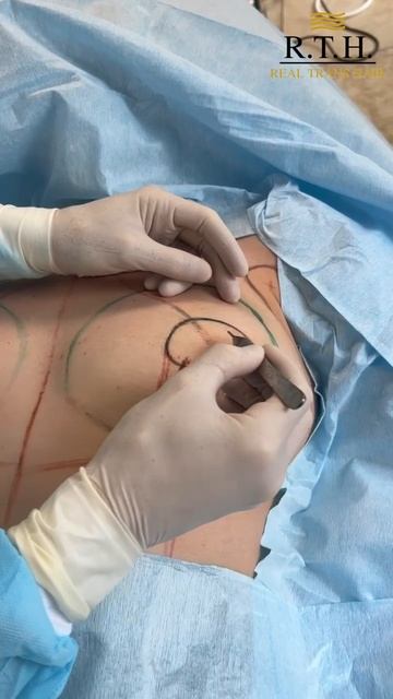 До и сразу после подтяжки и груди смотреть онлайн