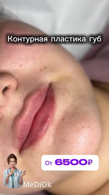 Коррекция губ