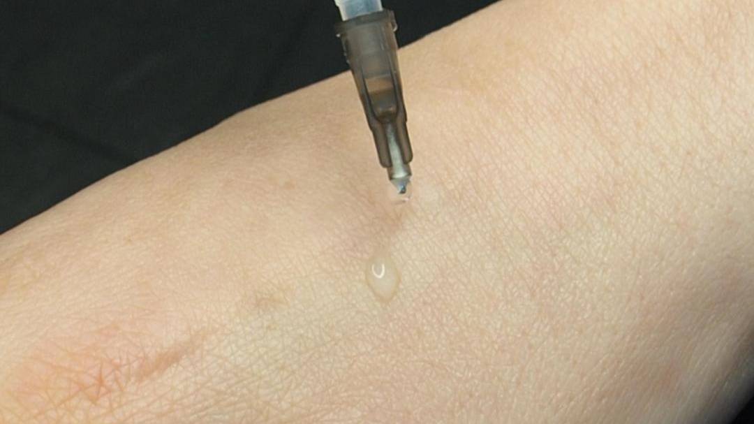 Как работает фракционная мезотерапия смотреть онлайн