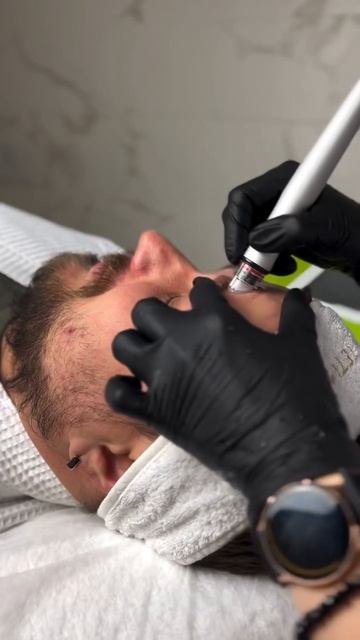 Вакуумная чистка Hydra Peel для мужского ухода