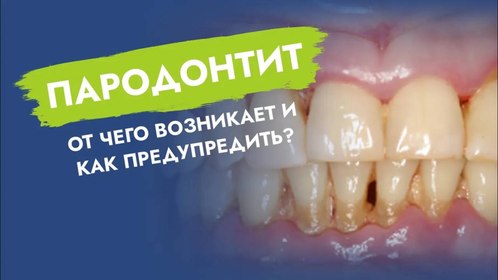 Самое опасное для зубов стоматологическое заболевание!