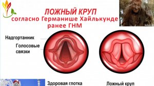 Псевдокруп. Ложный круп.  #Германише #ГНМ #5БЗ #GNM