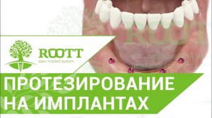Наглядно: процесс имплантации зубов на нижней челюсти. Протезирование на имплантах ROOTT