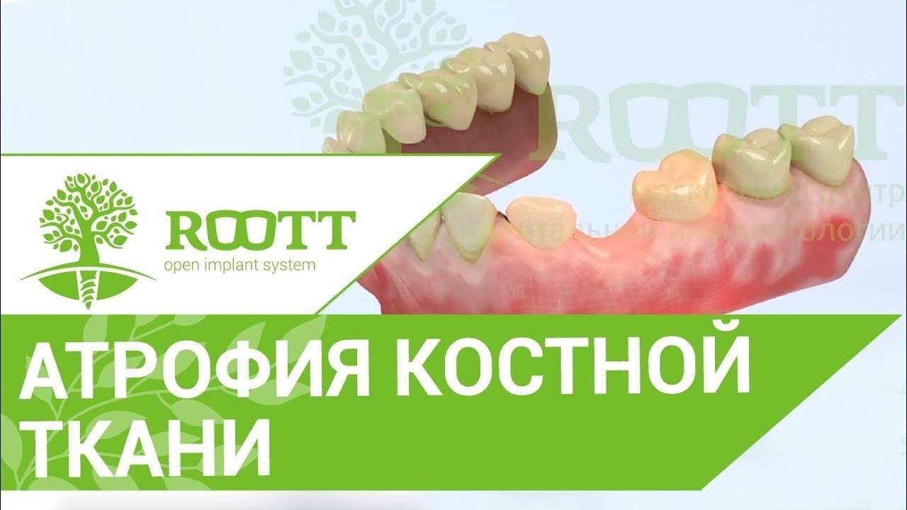Атрофия костной ткани. Чем опасна атрофия костной ткани? Клиника ROOTT смотреть онлайн