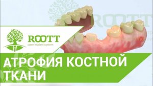 Атрофия костной ткани. Чем опасна атрофия костной ткани? Клиника ROOTT