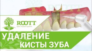 Резекция верхушки корня зуба. Как проходит операция резекции верхушки корня зуб? ROOTT IMPLANTS