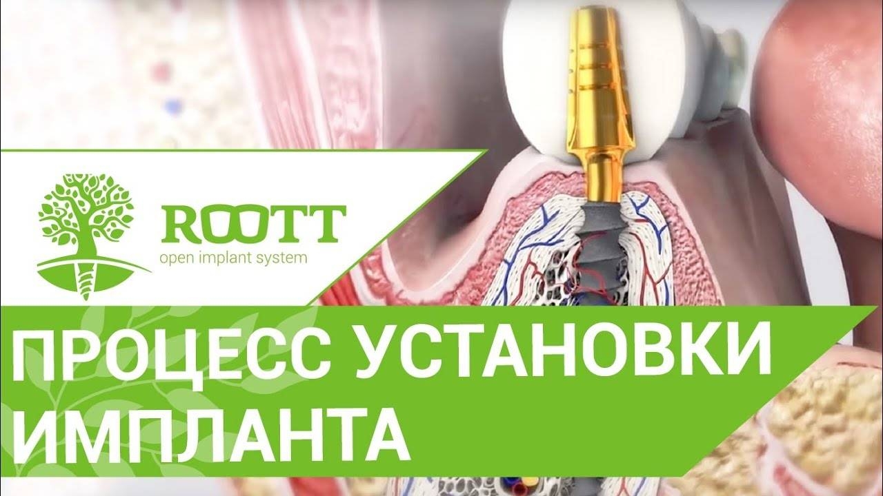 Установка зубных имплантов. происходит установка зубных имплантов. Клиника ROOTT  Как