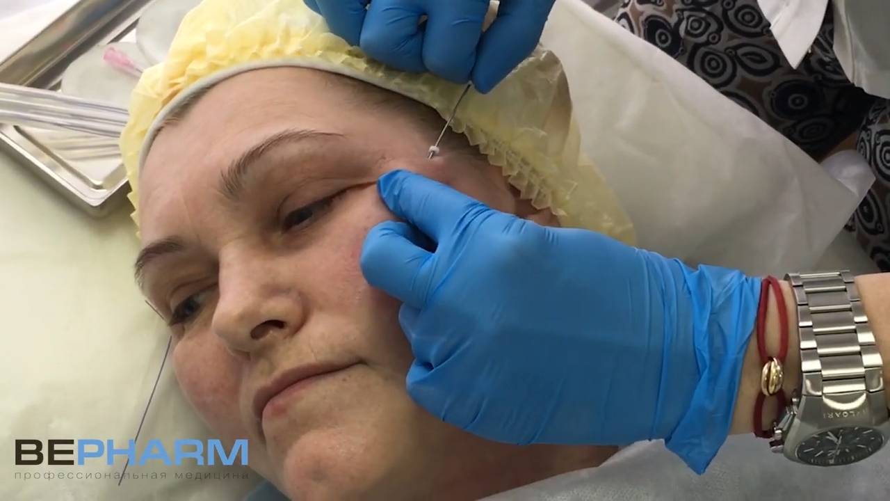 Имплантация мезонитей на канюле смотреть онлайн