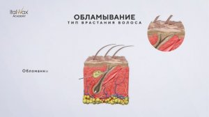 5. Типы врастания волос_озвучка