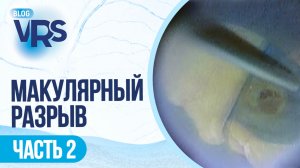 Макулярный разрыв / часть 2
