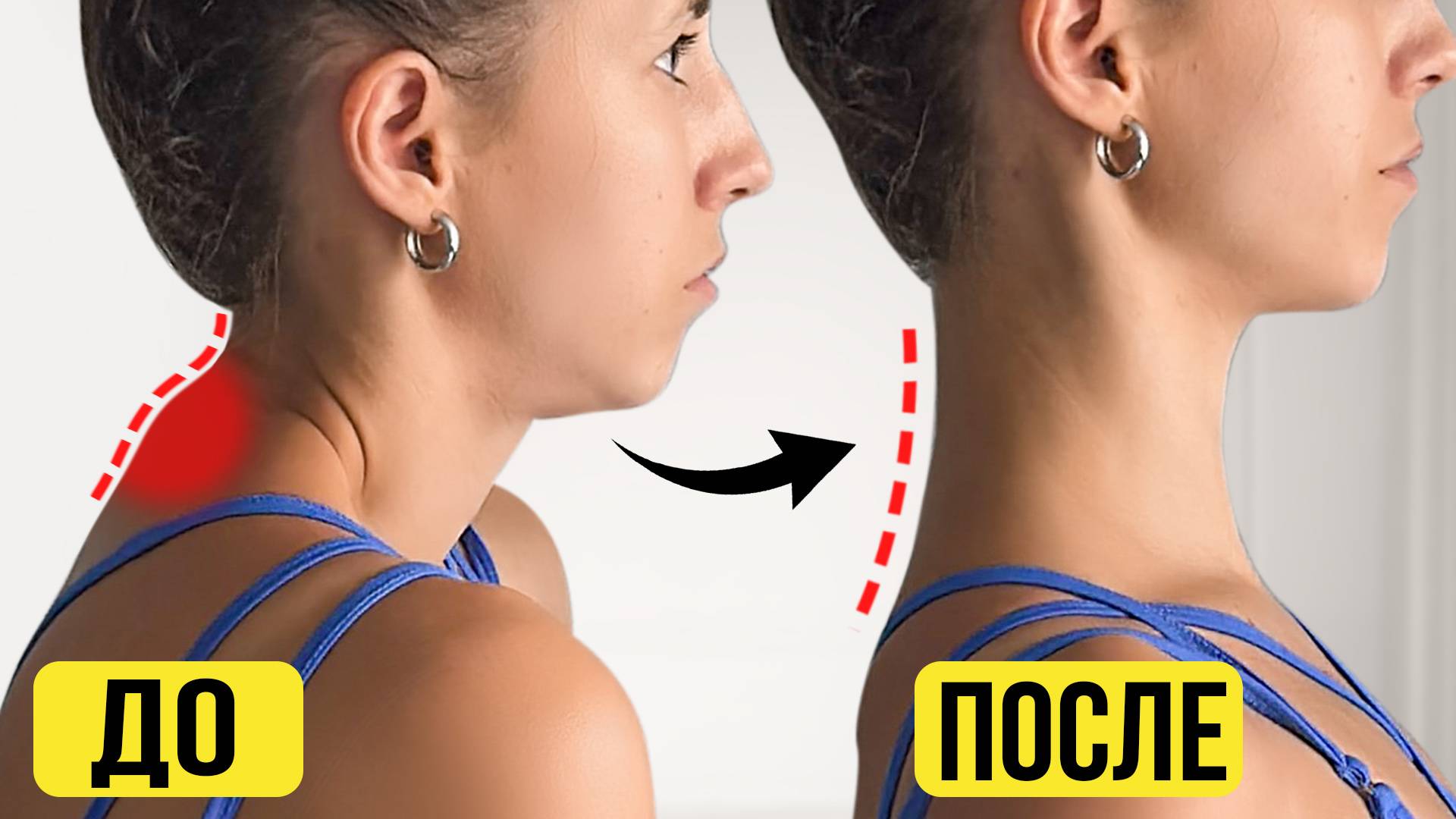 Как убрать холку на шее за 10 МИНУТ в день? Быстрое исправление горбинки на шее смотреть онлайн