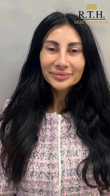 2 недели после блефаропластики✅ смотреть онлайн