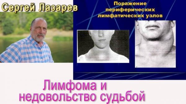 Сергей Николаевич Лазарев Лимфома
