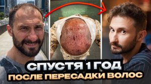 Спустя 1 год после пересадки волос: итоги, результат, стоит ли оно того?