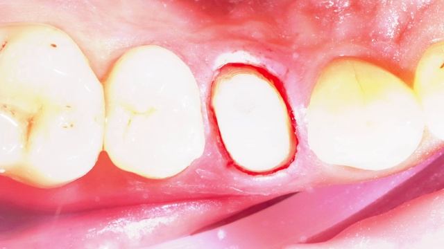 Пришел без зуба, ушёл с зубом