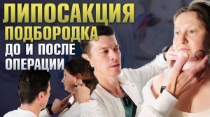 Выполняю липосакцию подбородка / Ультразвуковая липосакция подбородка: до и сразу после /  Vaser