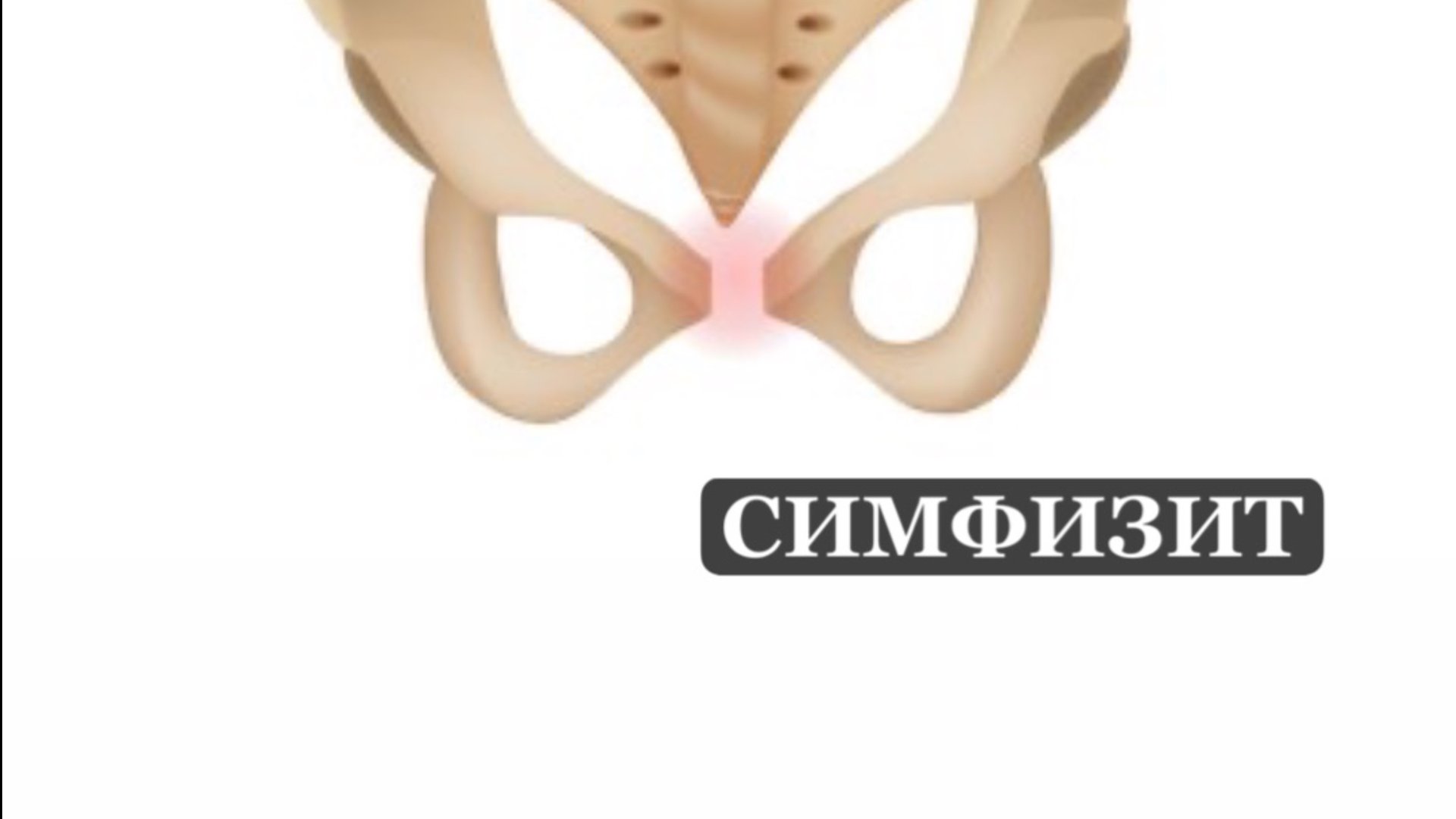 Симфизит во время беременности смотреть онлайн