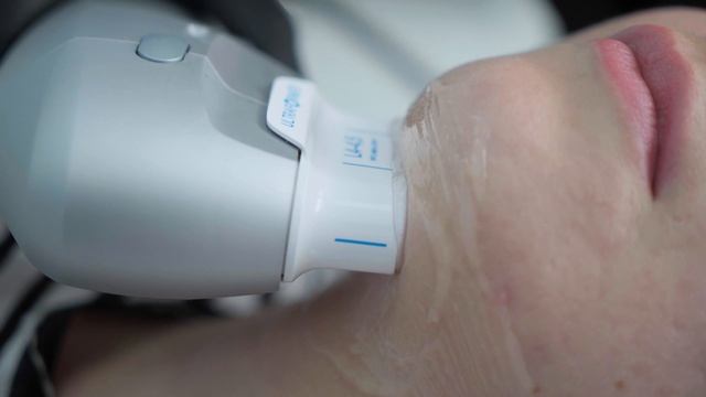 SMAS лифтинг на аппарате Ultraformer смотреть онлайн