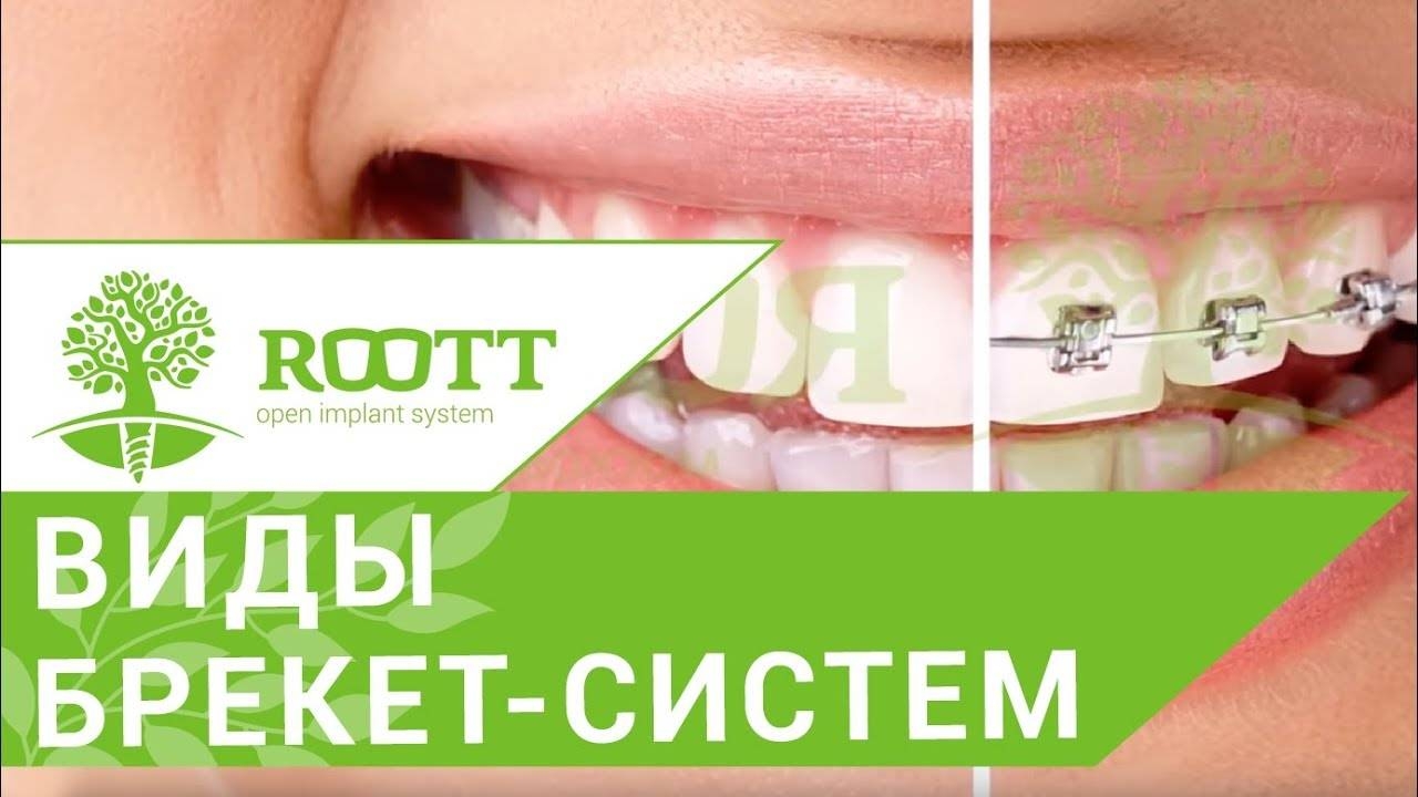 Разновидности брекетов. Капы и разновидности брекет-системы имплантологического центра ROOTT. смотреть онлайн