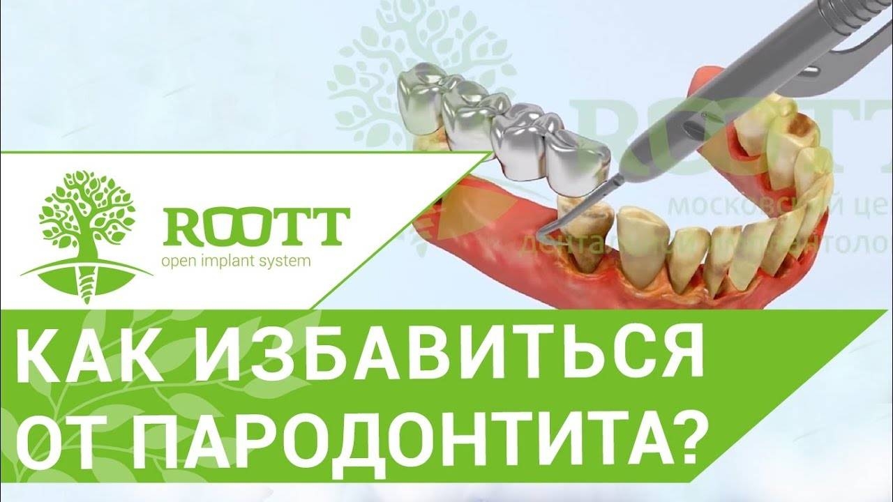 Пародонтит операция. Как проходит операция имплантации при пародонтите тяжелой степени? смотреть онлайн