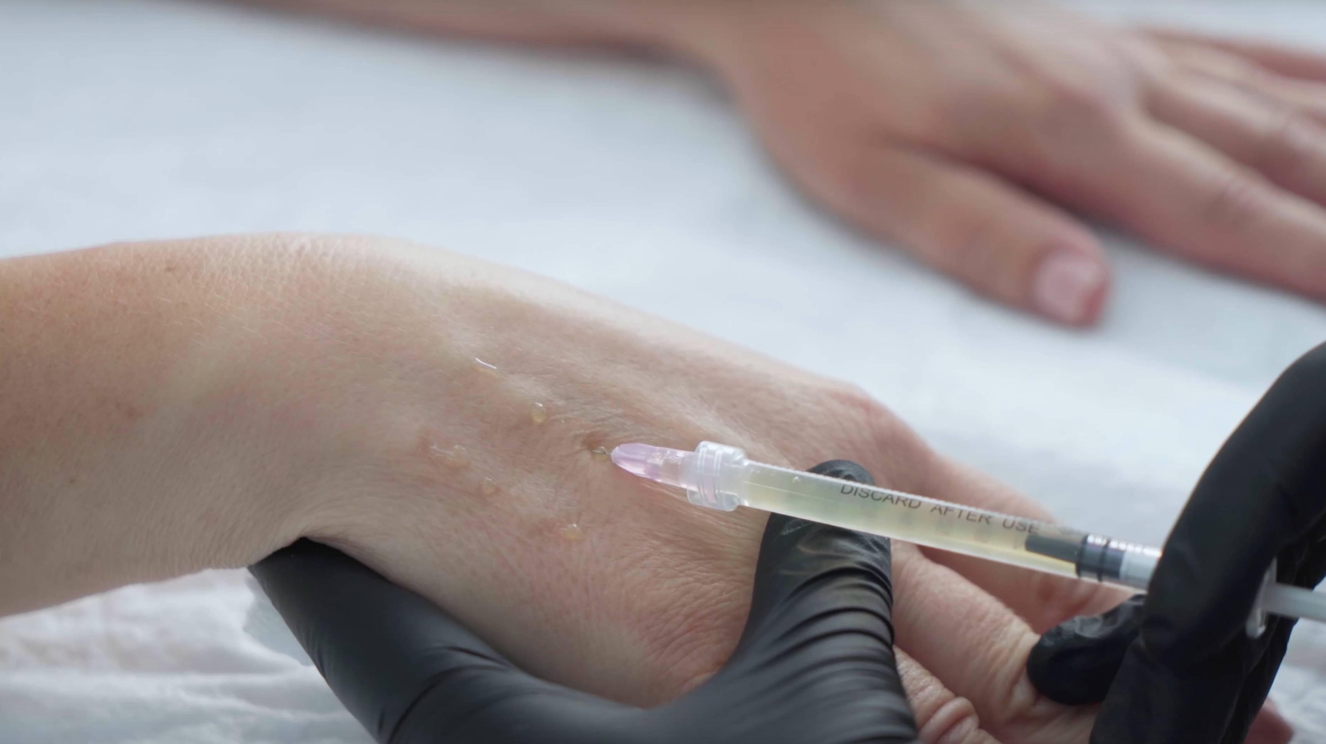 Терапия аутологичной плазмой (плазмотерапия, плазмолифтинг) смотреть онлайн