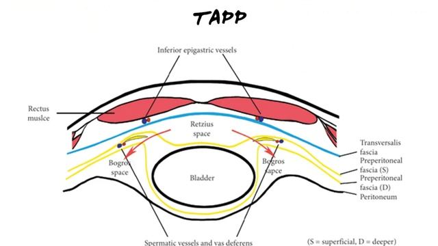 Паховая грыжа. Трансабдоминальная герниопластика TAPP при паховой грыже смотреть онлайн