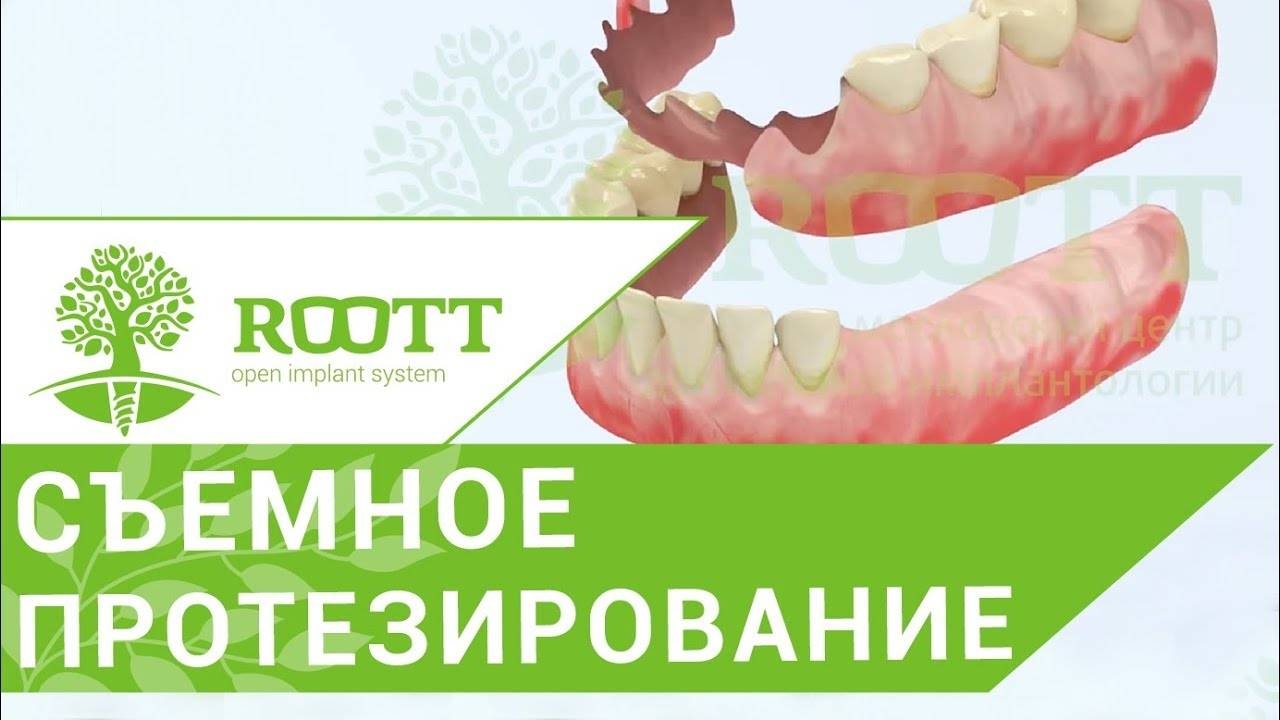 Съемное протезирование. Частично - съемное протезирование после удаления зуба. Клиника ROOTT смотреть онлайн