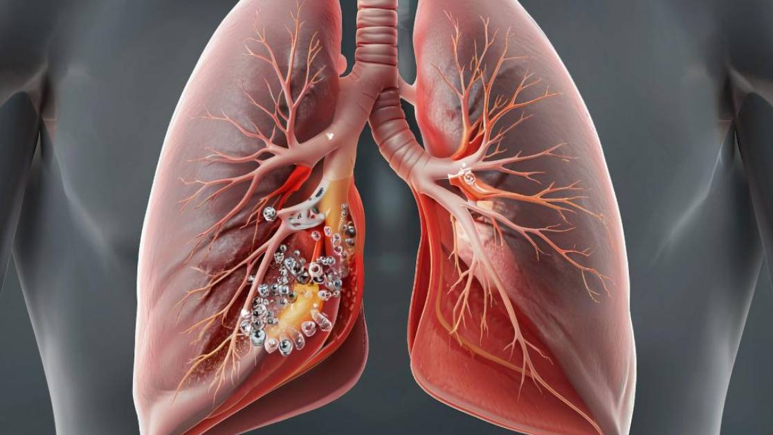 Отек Легких - Этиология, Патогенез, Классификация, Клиника, Диагностика, Лечение _ Терапия смотреть онлайн