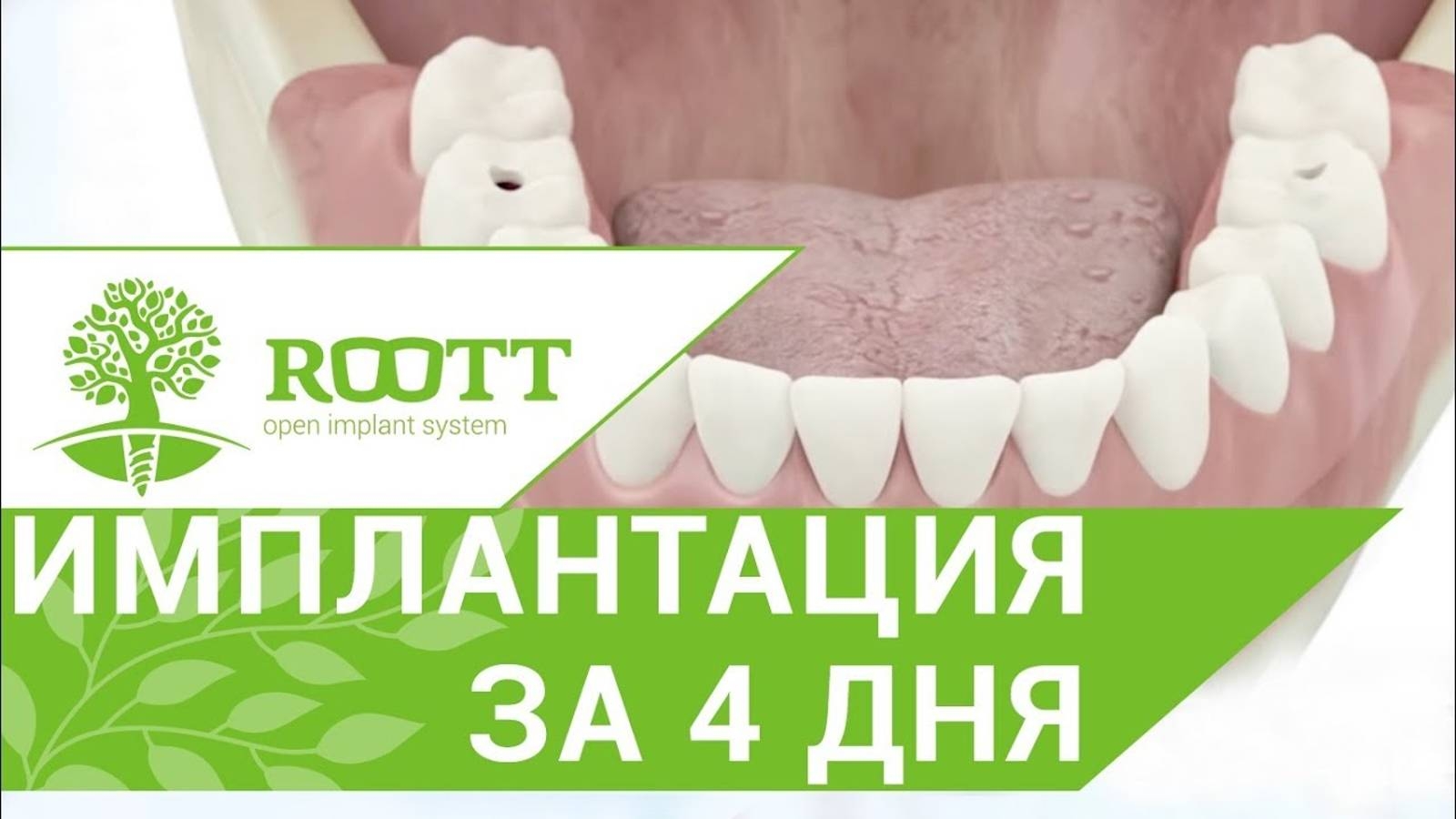 Однофазная имплантация. Уникальный способ комплексной однофазной имплантации зубов. ROOTT смотреть онлайн