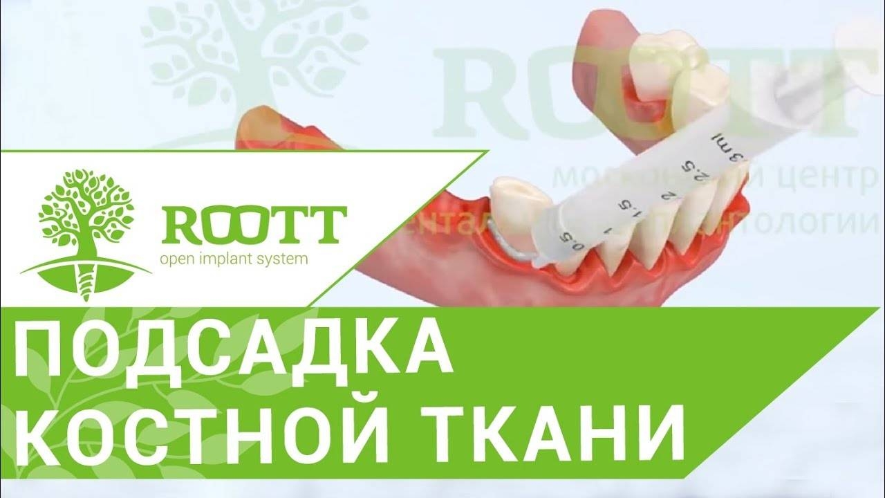Кюретаж десен. Открытый кюретаж пародонтальных карманов десен. Стоматология ROOTT смотреть онлайн