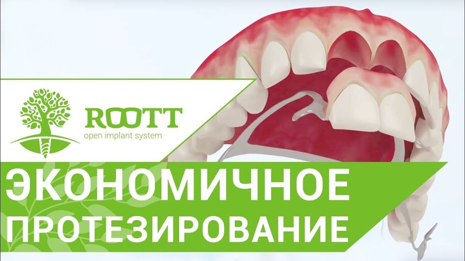 Бюгельный протез на кламмерах - бюджетный вид протезирования в ROOTT смотреть онлайн