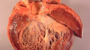 Кардиомиопатии - Этиология, Патогенез, Классификация (Терапия) _ Дилатационная, Гипертрофическая КМП