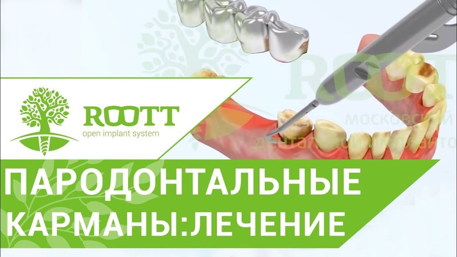 ПАРОДОНТАЛЬНЫЕ КАРМАНЫ. смотреть онлайн