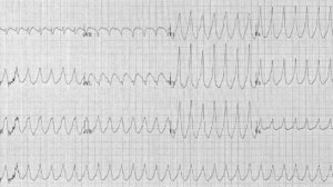 Пароксизмальная Тахикардия - Этиология Классификация Клиника Симптомы Диагностика Лечение (Терапия)
