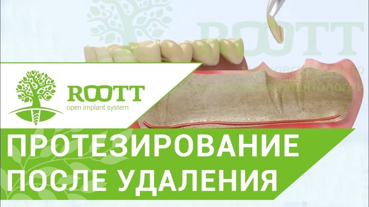 Съемное протезирование. Частично съемное протезирование после удаления зуба. ROOTT. смотреть онлайн