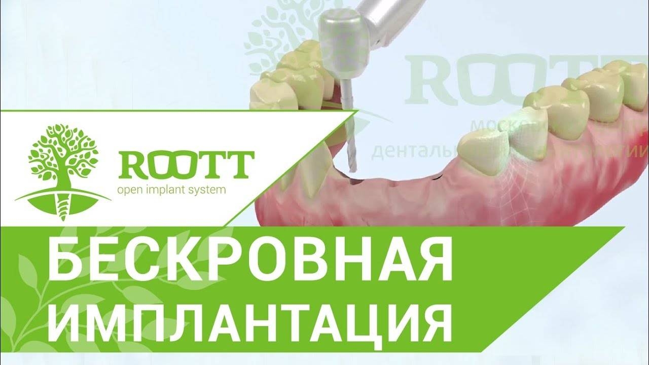 Имплантация зубов без разреза десны. Этапы имплантации зубов без разреза десны. ROOTT. смотреть онлайн