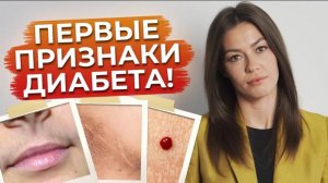 Как не допустить сахарный диабет? / Признаки сахарного диабета