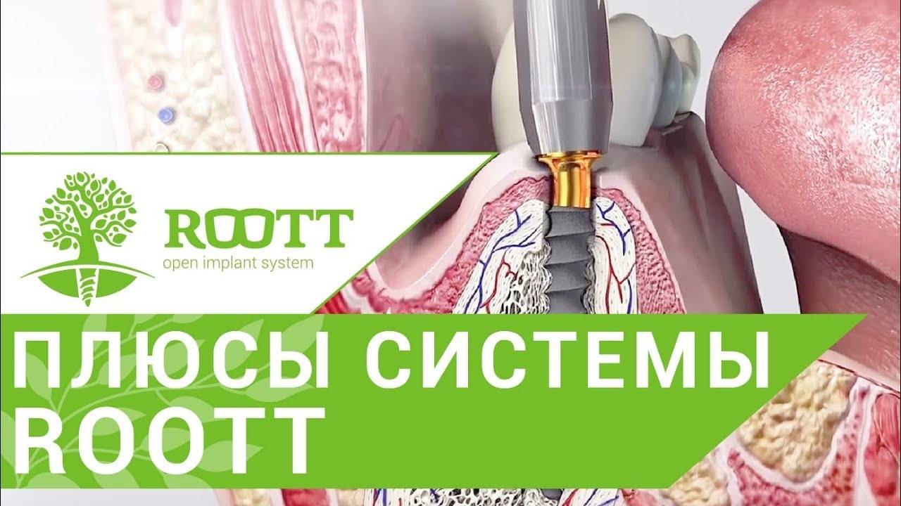 Современные импланты. Преимущества установки современных имплантов ROOTT смотреть онлайн