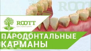 Лечение пародонтальных карманов. Способы лечения пародонтальных карманов десен. ROOTT.