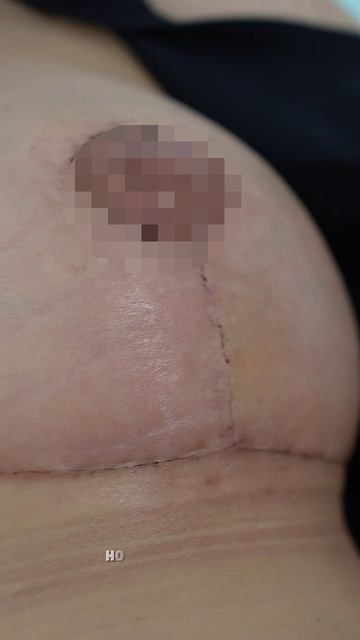 Мастопексия - результат пластики груди спустя 12 дней после операции