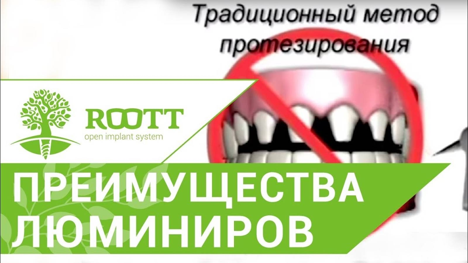 Люминиры или виниры. Почему люминиры устанавливают чаще, чем виниры. ROOTT смотреть онлайн