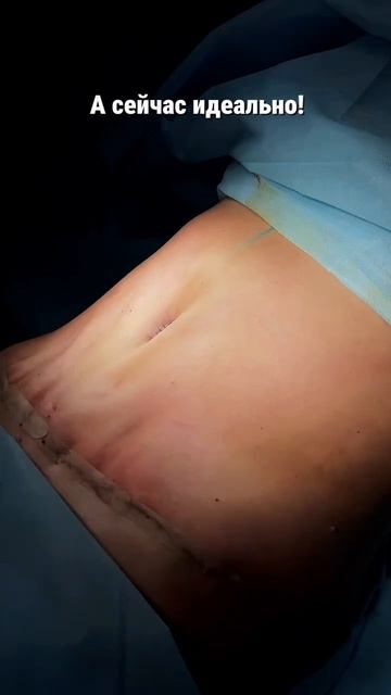 Липоабдоминопластика - результат сразу на операционном столе