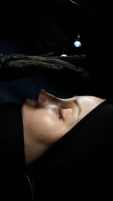 Великолепная трансформация: пластика носа до и сразу после