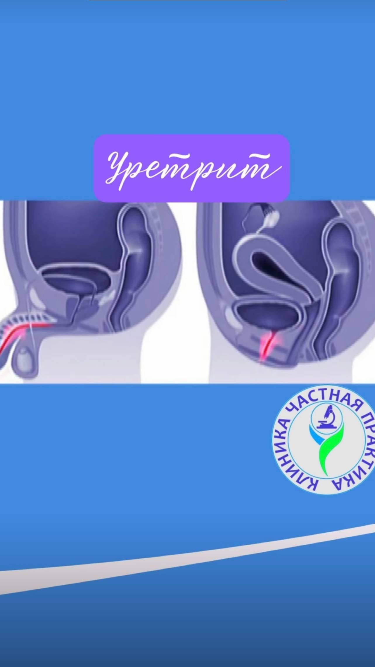 Уретрит смотреть онлайн